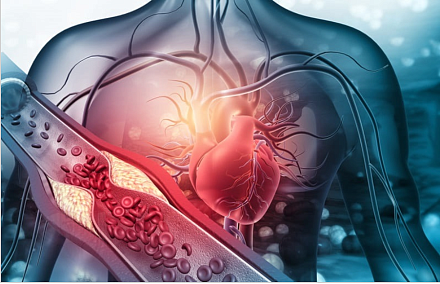 Новая шкала риска на основе липидов в крови улучшает прогнозирование сердечных заболеваний